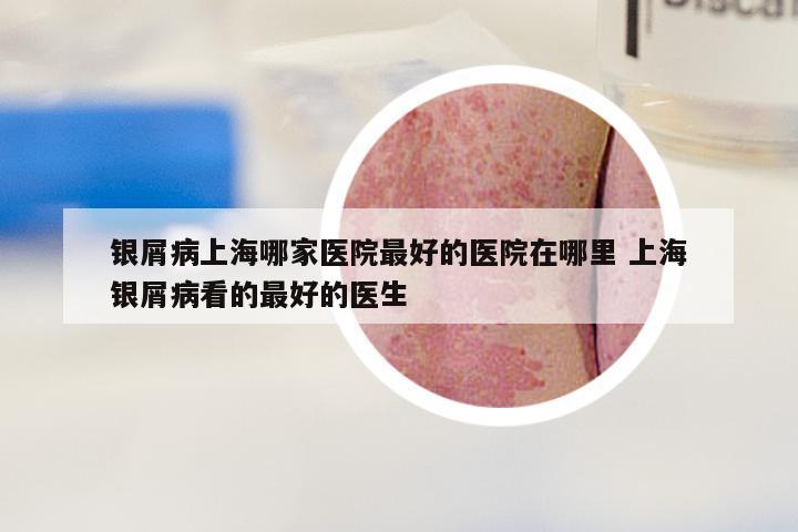 银屑病上海哪家医院最好的医院在哪里 上海银屑病看的最好的医生