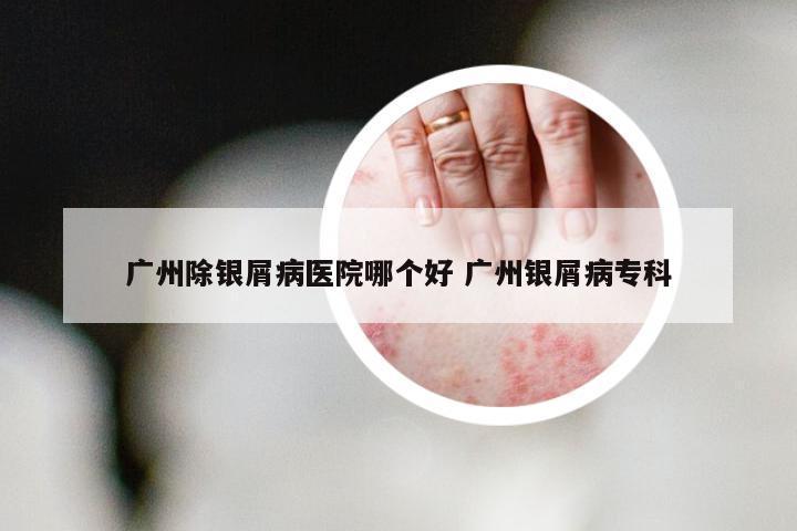 广州除银屑病医院哪个好 广州银屑病专科