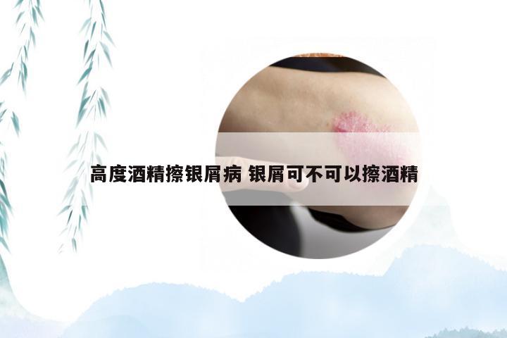 高度酒精擦银屑病 银屑可不可以擦酒精