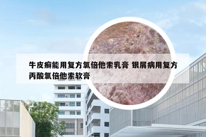 牛皮癣能用复方氯倍他索乳膏 银屑病用复方丙酸氯倍他索软膏