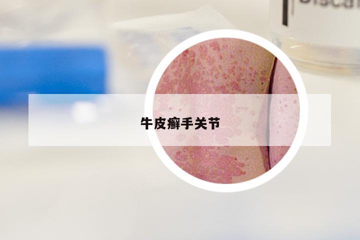 牛皮癣手关节
