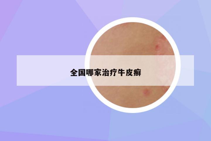 全国哪家治疗牛皮癣