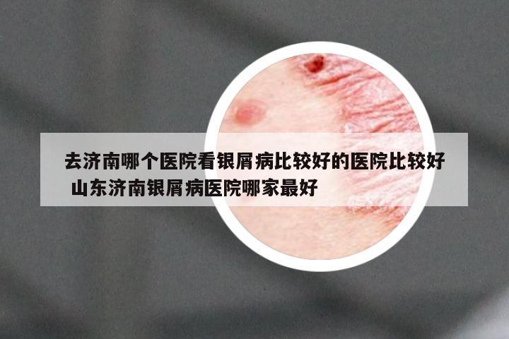 去济南哪个医院看银屑病比较好的医院比较好 山东济南银屑病医院哪家最好