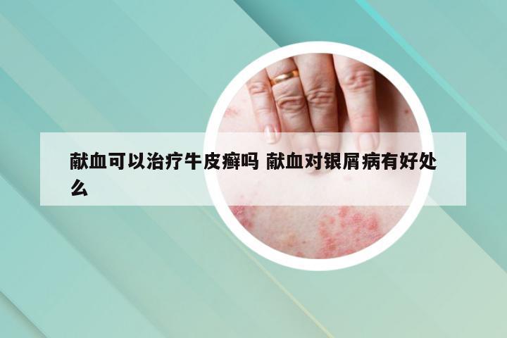献血可以治疗牛皮癣吗 献血对银屑病有好处么