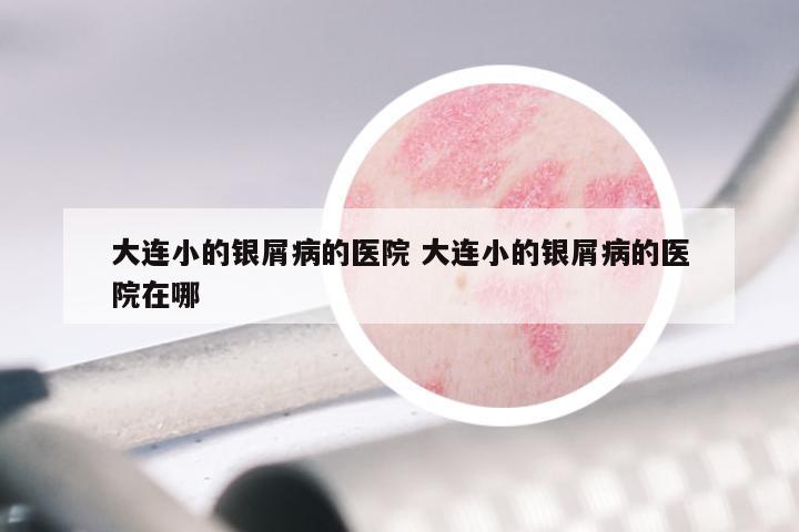 大连小的银屑病的医院 大连小的银屑病的医院在哪
