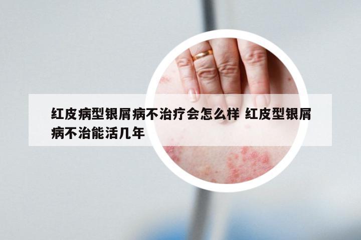 红皮病型银屑病不治疗会怎么样 红皮型银屑病不治能活几年