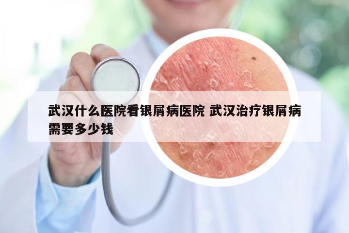 武汉什么医院看银屑病医院 武汉治疗银屑病需要多少钱
