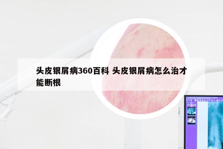 头皮银屑病360百科 头皮银屑病怎么治才能断根
