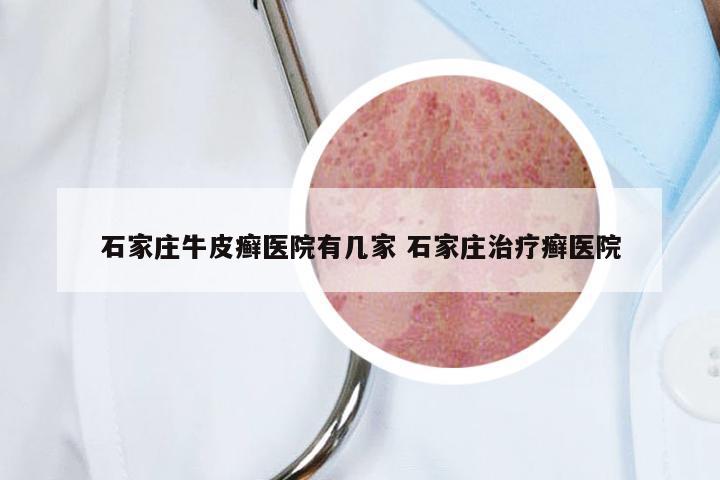 石家庄牛皮癣医院有几家 石家庄治疗癣医院