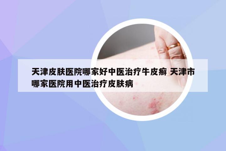 天津皮肤医院哪家好中医治疗牛皮癣 天津市哪家医院用中医治疗皮肤病