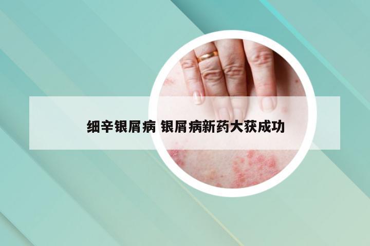 细辛银屑病 银屑病新药大获成功
