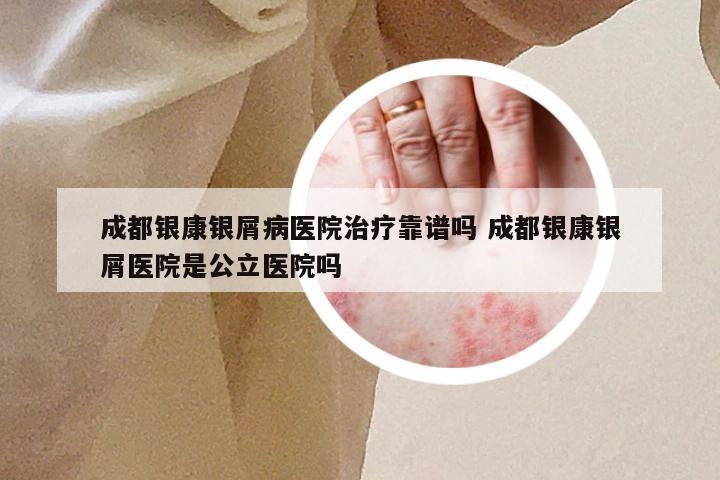成都银康银屑病医院治疗靠谱吗 成都银康银屑医院是公立医院吗