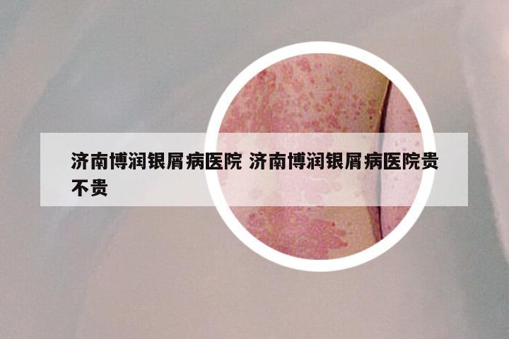 济南博润银屑病医院 济南博润银屑病医院贵不贵