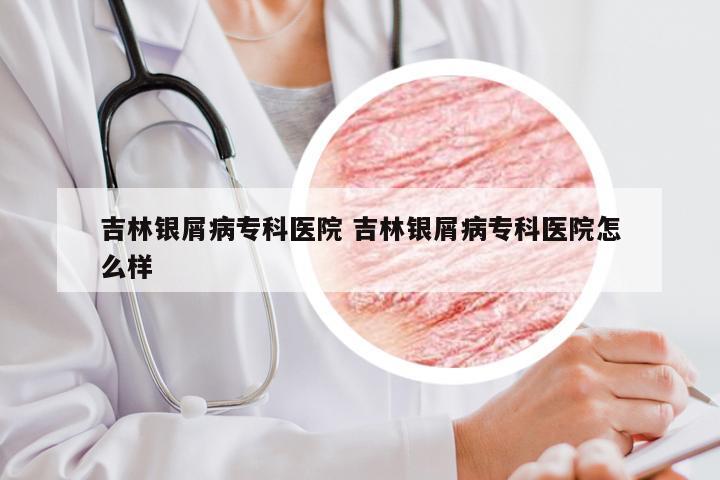 吉林银屑病专科医院 吉林银屑病专科医院怎么样