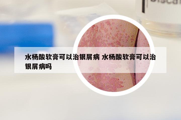 水杨酸软膏可以治银屑病 水杨酸软膏可以治银屑病吗