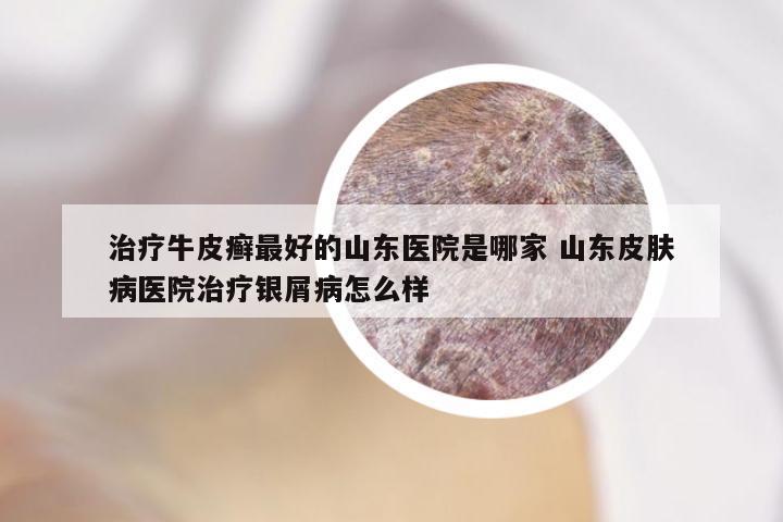 治疗牛皮癣最好的山东医院是哪家 山东皮肤病医院治疗银屑病怎么样