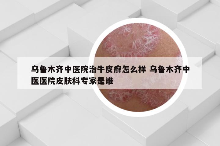 乌鲁木齐中医院治牛皮癣怎么样 乌鲁木齐中医医院皮肤科专家是谁