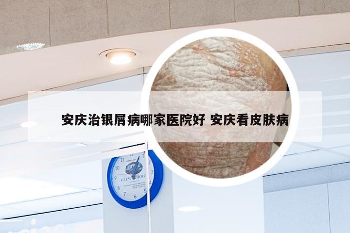 安庆治银屑病哪家医院好 安庆看皮肤病