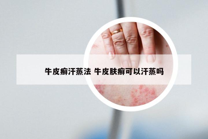 牛皮癣汗蒸法 牛皮肤癣可以汗蒸吗