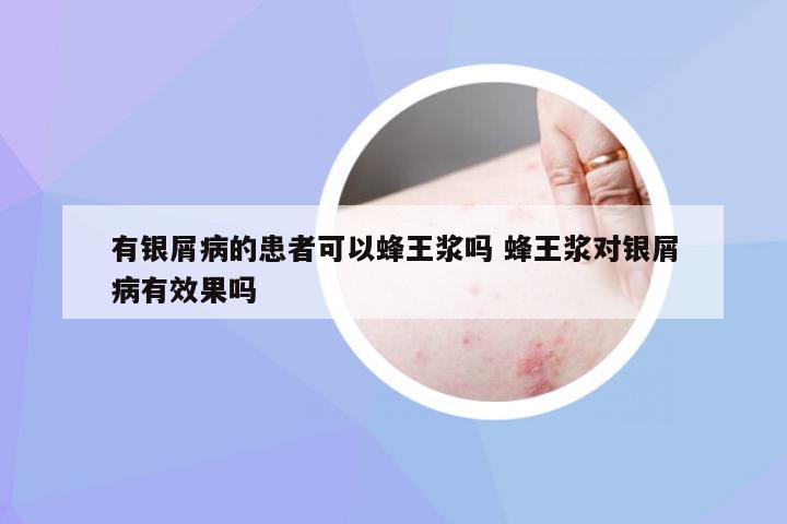 有银屑病的患者可以蜂王浆吗 蜂王浆对银屑病有效果吗