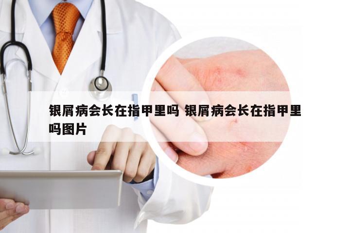 银屑病会长在指甲里吗 银屑病会长在指甲里吗图片