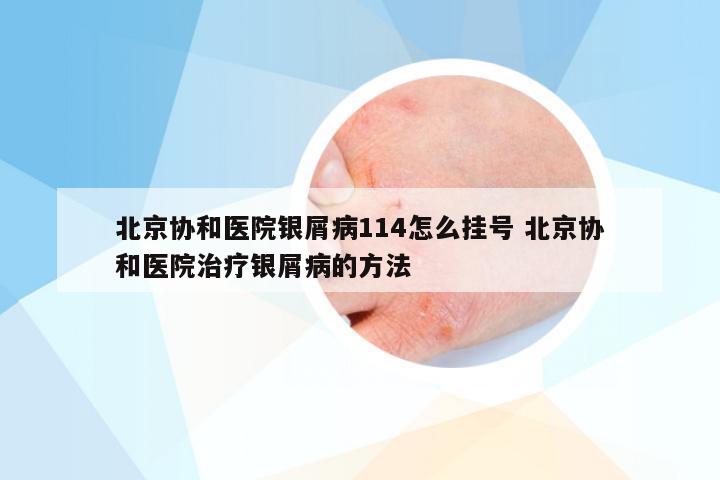 北京协和医院银屑病114怎么挂号 北京协和医院治疗银屑病的方法