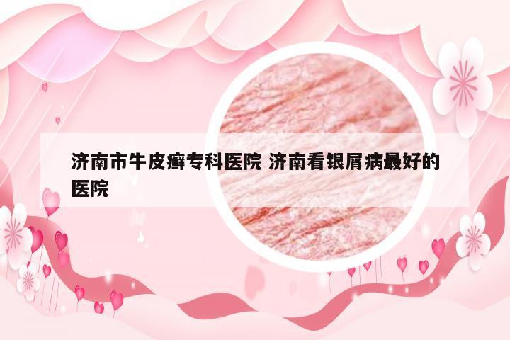 济南市牛皮癣专科医院 济南看银屑病最好的医院