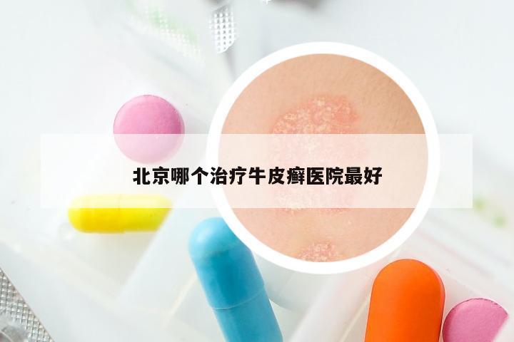 北京哪个治疗牛皮癣医院最好