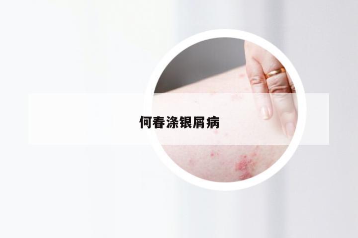 何春涤银屑病