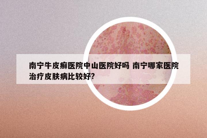 南宁牛皮癣医院中山医院好吗 南宁哪家医院治疗皮肤病比较好?
