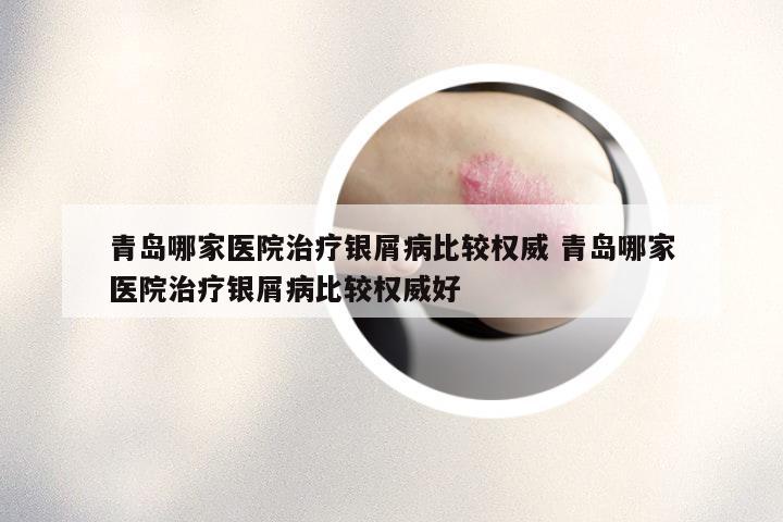 青岛哪家医院治疗银屑病比较权威 青岛哪家医院治疗银屑病比较权威好
