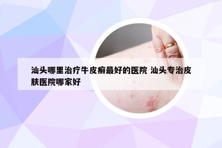 汕头哪里治疗牛皮癣最好的医院 汕头专治皮肤医院哪家好