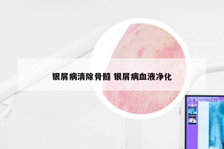 银屑病清除骨髓 银屑病血液净化