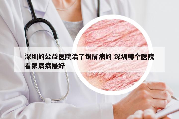 深圳的公益医院治了银屑病的 深圳哪个医院看银屑病最好
