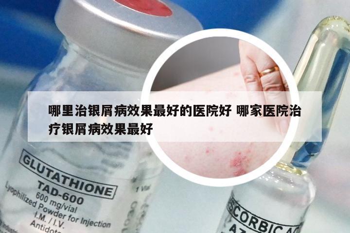 哪里治银屑病效果最好的医院好 哪家医院治疗银屑病效果最好