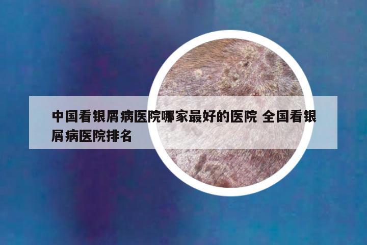 中国看银屑病医院哪家最好的医院 全国看银屑病医院排名