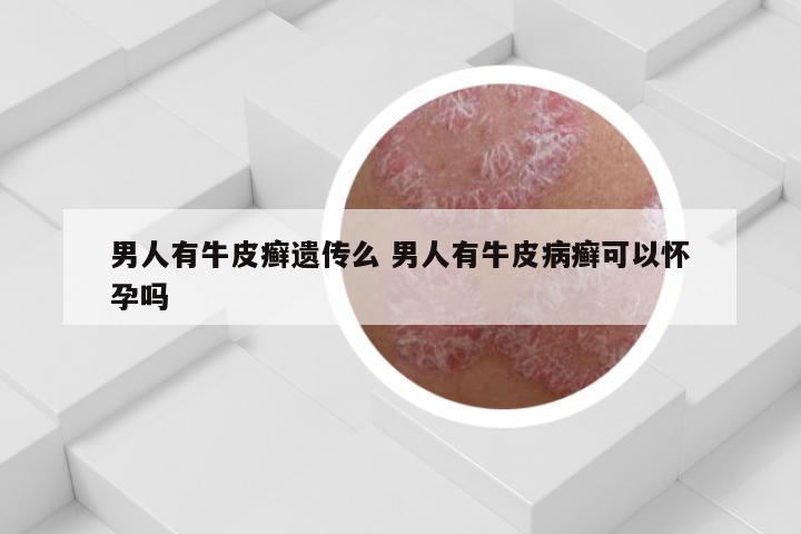 男人有牛皮癣遗传么 男人有牛皮病癣可以怀孕吗