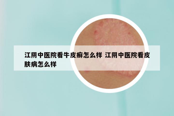 江阴中医院看牛皮癣怎么样 江阴中医院看皮肤病怎么样