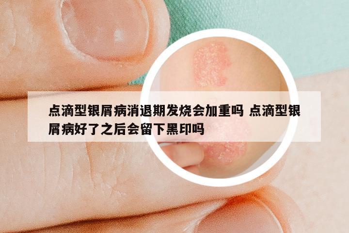 点滴型银屑病消退期发烧会加重吗 点滴型银屑病好了之后会留下黑印吗