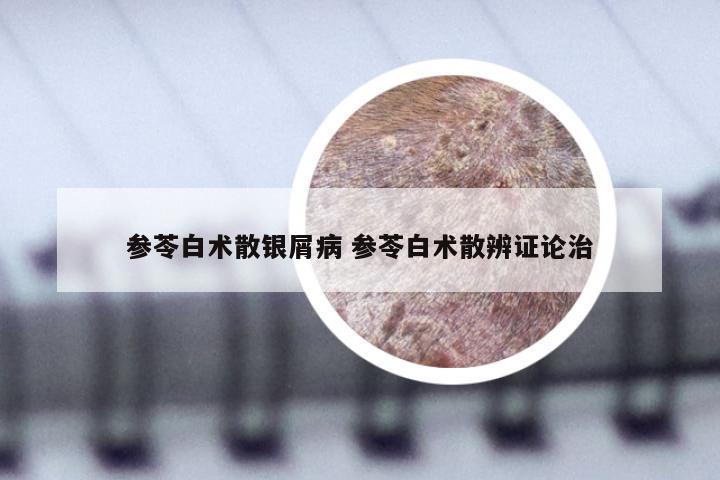 参苓白术散银屑病 参苓白术散辨证论治