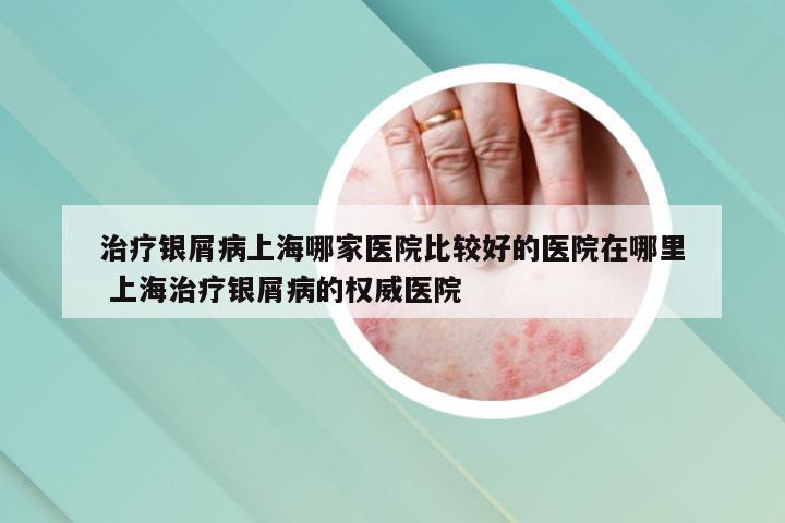 治疗银屑病上海哪家医院比较好的医院在哪里 上海治疗银屑病的权威医院