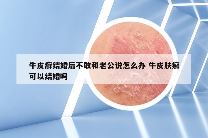 牛皮癣结婚后不敢和老公说怎么办 牛皮肤癣可以结婚吗