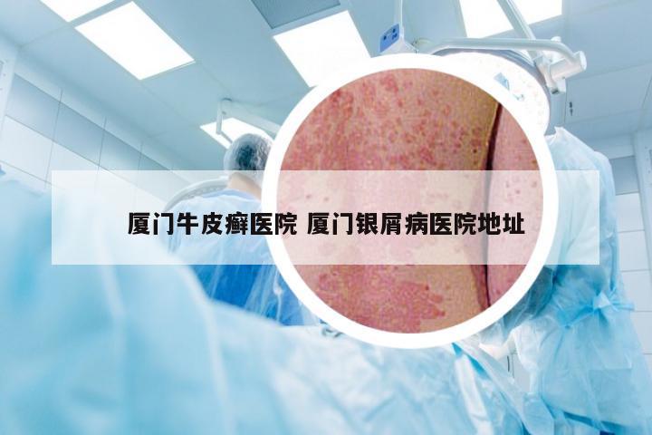 厦门牛皮癣医院 厦门银屑病医院地址
