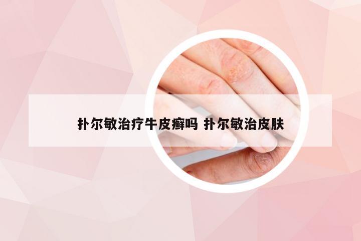 扑尔敏治疗牛皮癣吗 扑尔敏治皮肤