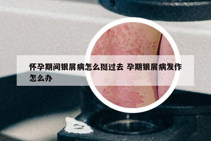怀孕期间银屑病怎么挺过去 孕期银屑病发作怎么办