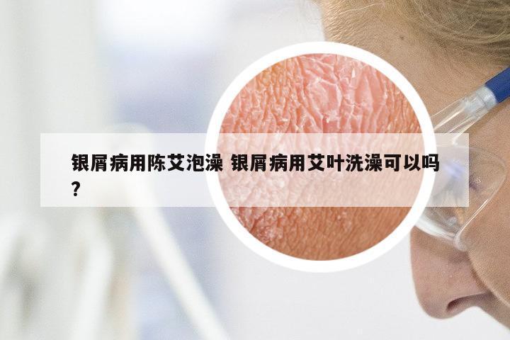 银屑病用陈艾泡澡 银屑病用艾叶洗澡可以吗?