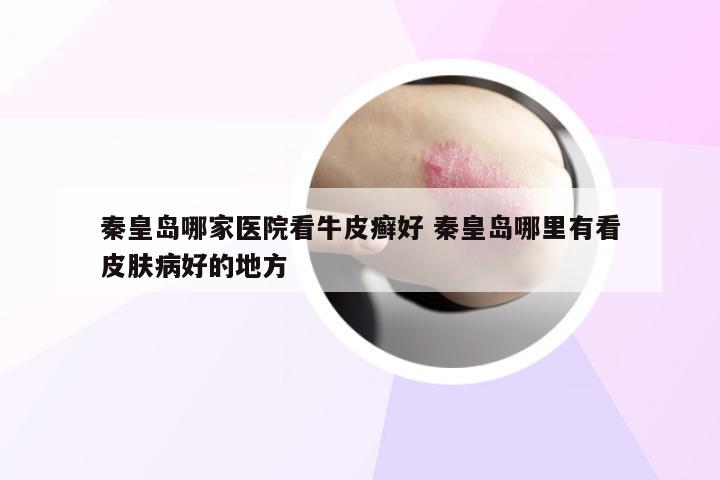 秦皇岛哪家医院看牛皮癣好 秦皇岛哪里有看皮肤病好的地方