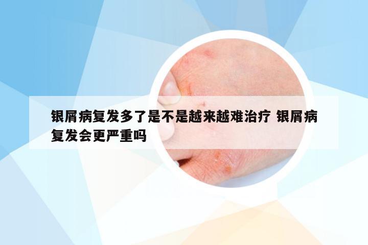 银屑病复发多了是不是越来越难治疗 银屑病复发会更严重吗