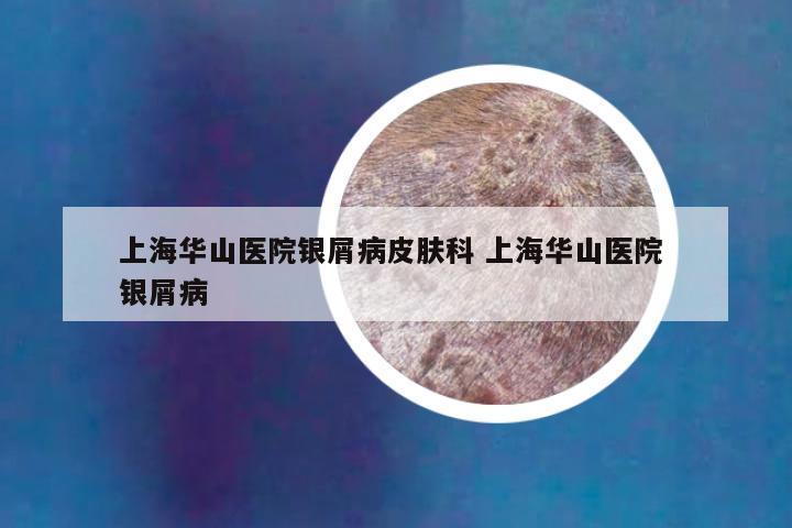 上海华山医院银屑病皮肤科 上海华山医院 银屑病