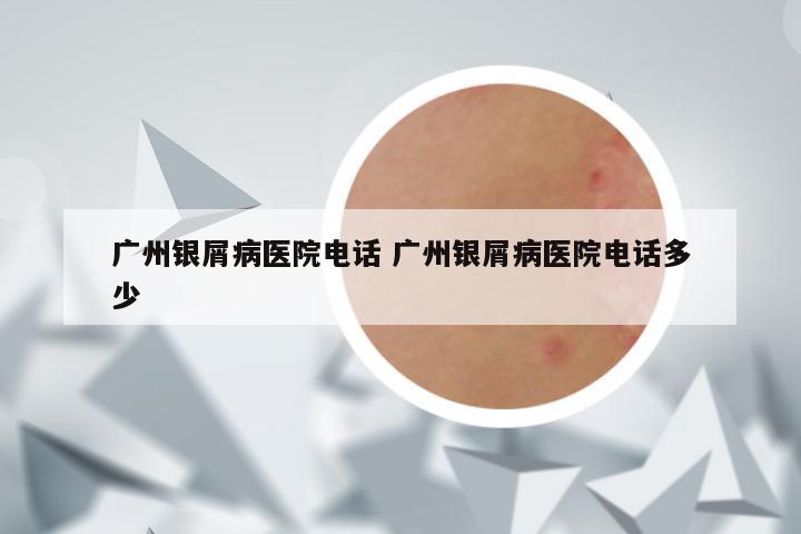 广州银屑病医院电话 广州银屑病医院电话多少